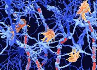 Detecting Early Signs of Multiple Sclerosis through Twin Study news-20102024-230418