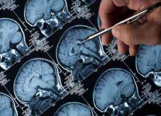 Alzheimer’s Drug Rejected for Widespread Use in NHS England – What Happens Next? news-23102024-174807