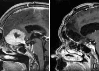 Innovative Brain Tumour Removal Through Eyebrows: A Breakthrough Surgery news-25102024-060905