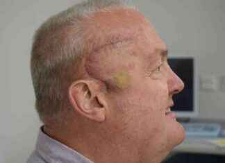 Successful Cancer Treatment Trial: Luton Man’s Brain Tumour Shrinks by Half with Radioactive Injections news-29102024-130916