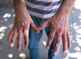 MPOX: Clade 1b Strain Detected in London – What You Need to Know news-31102024-143455