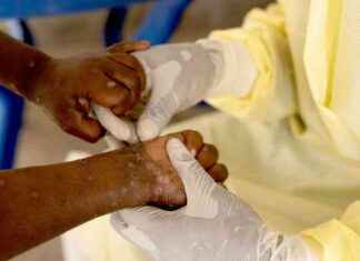 Understanding the Differences in the New MPOX Strain Found in the UK news-01112024-051519