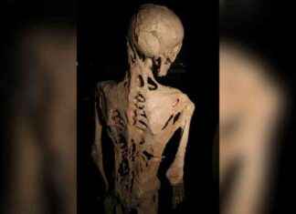 Stone Man Disease: Understanding the Rare Condition of Growing a Second Skeleton news-28112024-171723
