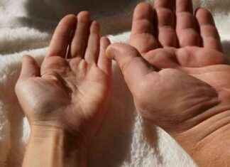 Understanding Acromegaly: Symptoms, Causes, and Treatment Options understanding-acromegaly-symptoms-causes-and-treatment-options