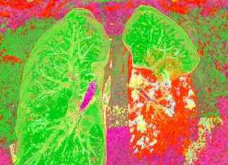 Updated Pneumonia Vaccine Guidelines for Increased Survival Rates updated-pneumonia-vaccine-guidelines-for-ncreased-survival-rates