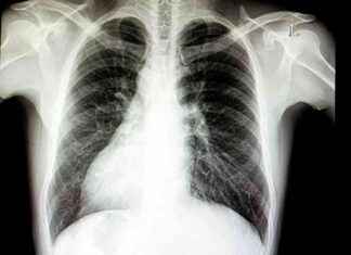 Understanding Situs Inversus: Organs on the ‘Wrong’ Side understanding-situs-nversus-organs-on-the-wrong-side