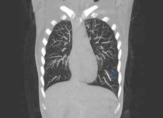 Contraceptive Implant Travels to Woman’s Lung: Rare Case contraceptive-mplant-travels-to-womans-lung-rare-case