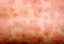 why-vaccines-are-mportant-during-texas-measles-outbreak