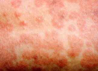 Why Vaccines Are Important During Texas Measles Outbreak why-vaccines-are-mportant-during-texas-measles-outbreak